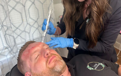 Microneedling