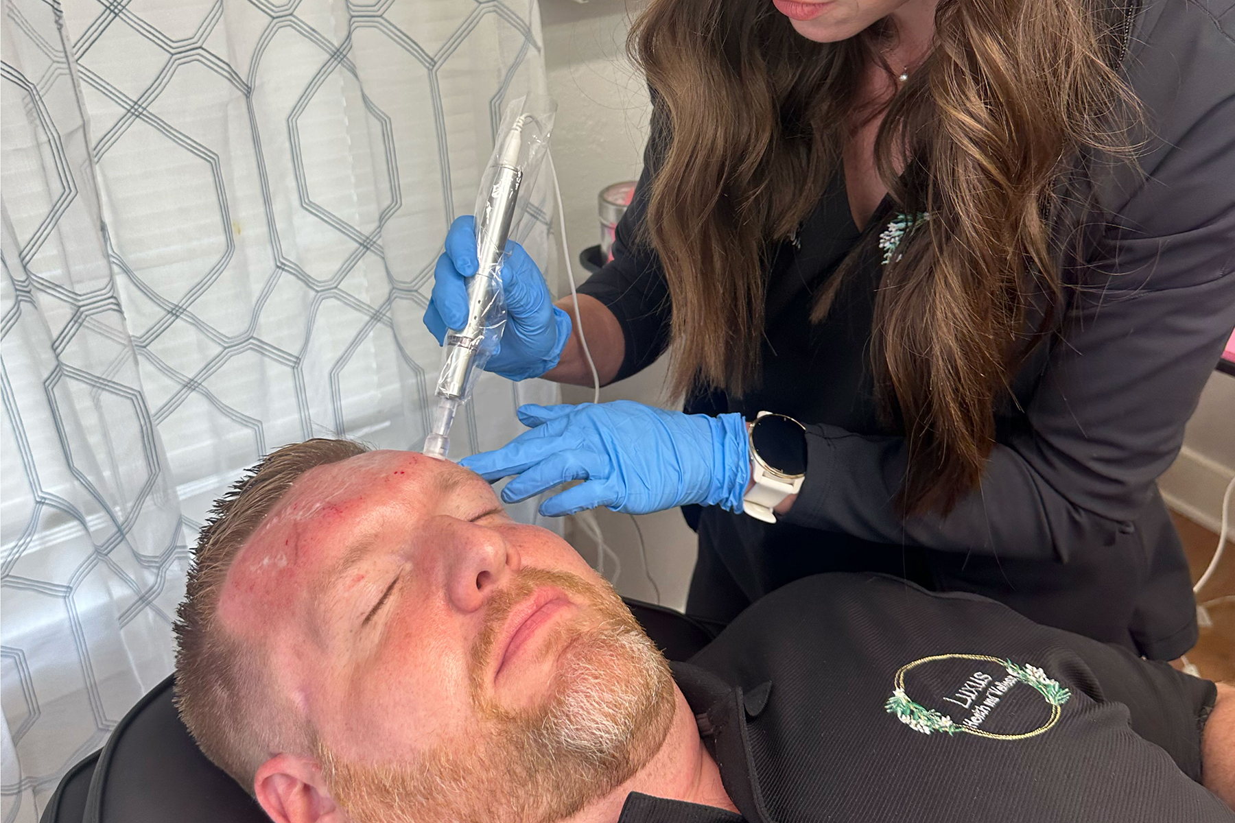 microneedling-1